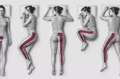 The Real Reason Your Sciatica Won't Go Away (And How to Fix It)